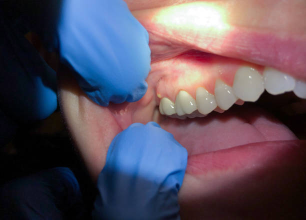 Best Emergency Root Canal Treatment in Country Clu, MO